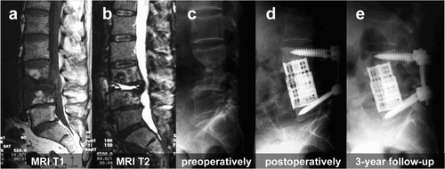 Figure 1. 73-year-old patient with spondylodiscitis at L3/4 and substantial bone loss. A 360-degree fusion using an anterior expandable titanium cage led to long-term stability.