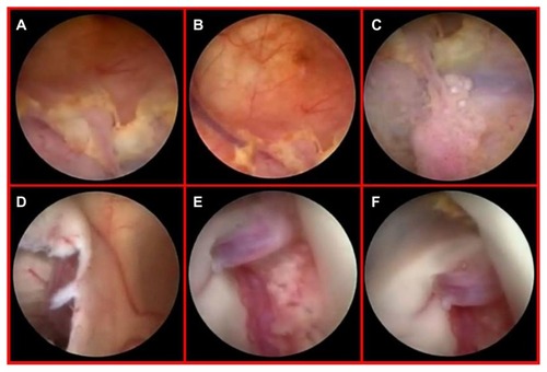 Figure 6 Diffuse yellowish coloration of the walls of the right lateral ventricle discovered during neuroendoscopic examination, with clusters of neoplastic cells embedding the choroid plexus and a thin sheet of tumor cells forming small nodules in the subependymal region (A–C). Endoscopic view of the septostomy with a contralateral apparently normal ependymal layer and choroid plexus (D and E). Close-up view of an initial, contralateral tumor infiltration evident through the fibers of the subependymal layer, situated along the anterior commissure (F). This finding was undetected by preoperative magnetic resonance imaging (see Figure 5D).