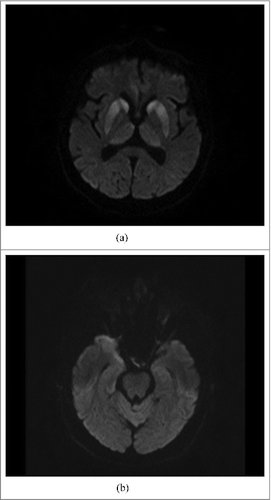 Figure 2. (A). MRI DWI: abnormal high signal intensity in both caudate nuclei, putamina and thalami, particularly prominent in heads of caudate nuclei and anterior parts of putamina (the same changes as seen on Fig. A). (B). MRI DWI: abnormal high signal intensity in cortex of anterior pole of the right temporal lobe and slight, linear hyperintensity in cortex of the left temporal lobe.
