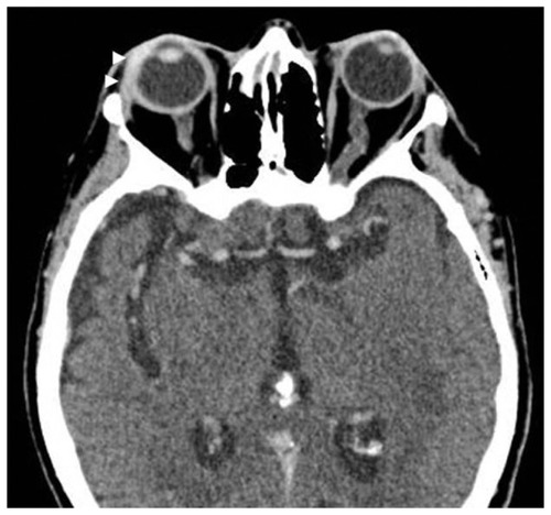 Figure 1 Contrast-enhanced axial CT of the orbit shows preseptal swelling and thickening of the orbital septum on the right. Note thickening and enhancement of uveal tract on right. No obvious abnormality seen in vitreous chamber.