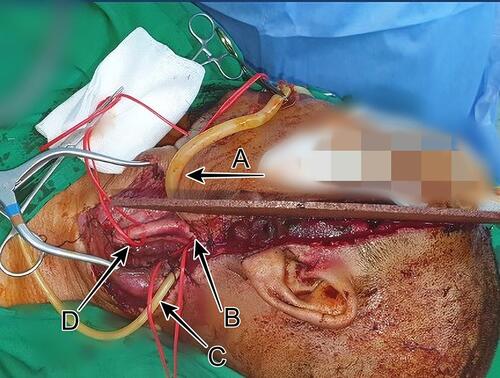 Figure 3 Technique of bleeding control. (A) External carotid artery occlusion; (B) internal carotid artery; (C) balloon tamponade; (D) common carotid artery.