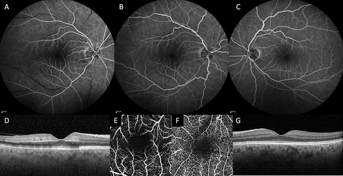 Figure 3 Multimodal imaging from an incomplete central retinal artery occlusion patient (case 2) taken at day 3 after combined intra-arterial nimodipine with alteplase. Visual acuity was improved from counting figure to 20/400 immediately after treatment and 20/40 at day 3. Fundus fluoresceine angiogram taken at 36 seconds and 1 minute (A and B) showing mild delayed retinal arterial filling time with intact perimacular arterioles in the affected eye, the fellow eye was normal (C). Optical coherence tomography revealed hyperreflectivity with minimal thickening of inner plexiform layer (D) compared to that of the fellow eye (G). Full thickness en face optical coherence tomography angiogram showed decreased vascular density of the affected eye (E) compared to that of the fellow eye (F).