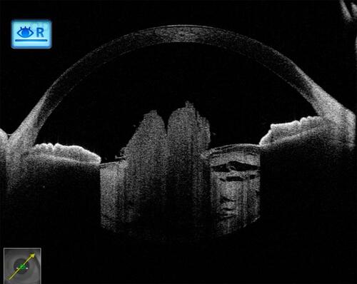 Figure 7 Post-traumatic cataract with partially absorbed lens matter showing a ruptured anterior capsule and matter spilling over into the anterior chamber. Again, here, in the presence of anterior dense opacity, posterior capsular details are very well appreciated before surgery.