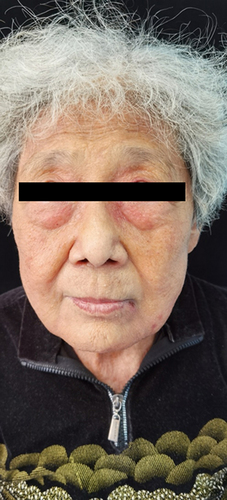 Figure 1 Symmetrical periorbital edema accompanied with purpura, and multiple flesh or brown-colored waxy, smooth, papules were on the patient’s face.