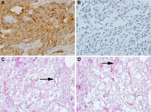 Figure 1 Representative immunohistochemical staining of OPN in breast cancer.