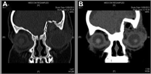Figure 3 Computed tomography scan of orbit and brain showed comminuted fracture of the left orbital roof (A) and left frontal brain contusion with prelesional edema (B).