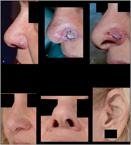 Figure 4. (A,B) A superficial defect, 2 mm from the alar rim, reconstructed with a composite graft to prevent alar retraction. (C) The composite graft at the first change of dressing after six days. (D–F) The results at five months follow-up, showing a good result with intact contour of the alar rim. Additionally, a good result at the donor site at the crus of helix.