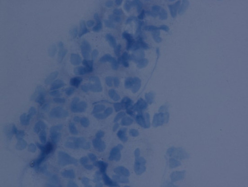Figure 4 Microscopic examination with Giemsa staining on the conjunctival sac smear revealed more neutrophils and a small number of diplococci.