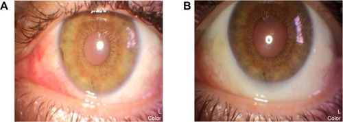 Figure 2 Represents the color photo of the left eye at pre-treatment and post-treatment phases.