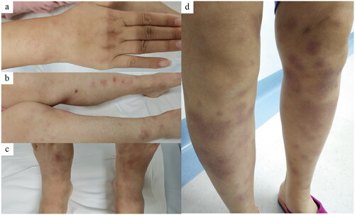 Figure 1. The skin lesions of Case 7 (a–c) and Case 12 (d).