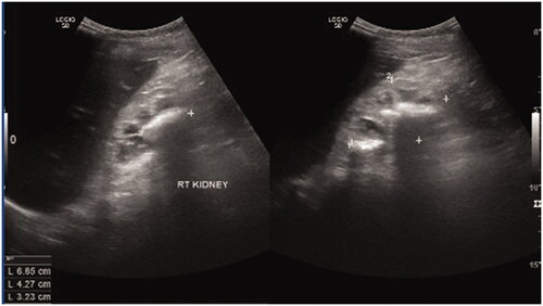 Figure 6. Multiple stones in the right renal pelvis.