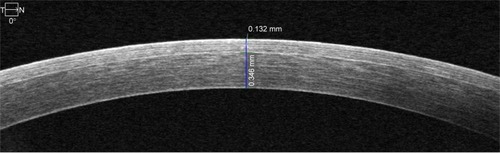 Figure 1 High-definition optical coherence tomography at center of cornea.