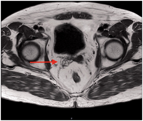 Figure 1. MRI T1 weighted non-fat suppressed image showing a right seminal vesicle bleed.