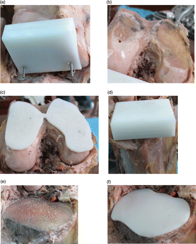 Figure 6. Cadaver undergoing TKA using the patient-specific navigational template technique. (a) The navigational template fits the femoral condyle perfectly. (b) and (c) The actual surface of the distal femur after osteotomy matches the surface shape from the virtual setting using the navigational template. (d) The navigational template fits the tibial plateau perfectly. (e) and (f) The actual surface of the proximal tibia after osteotomy matches the surface shape from the virtual setting using the navigational template.