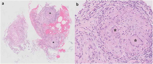 Figure 2. (a) Transbronchial biopsy specimen viewed at low magnification showing non-necrotizing granulomatous inflammation. Discrete granulomas are denoted by asterisks (Hematoxylin & eosin, original magnification x 20). (b) Higher magnification of one of the granulomas from (a) highlights the presence of multinucleated giant cells indicated by stars (Hematoxylin & eosin, original magnification x 40)