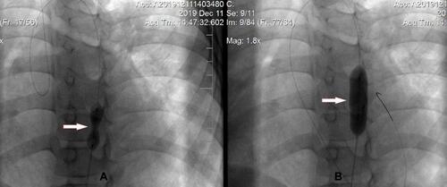 Figure 2 Percutaneous transluminal angioplasty was performed with Tyshask 8 (A) and 10 mm (B).