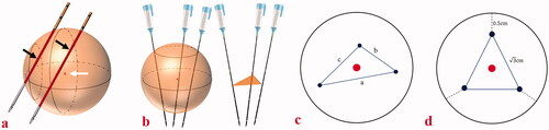 Figure 4. Photographs show assessments of needle placement performed on phantom models. (a) The specimen length (black arrows) of puncturing the center point (white arrow) of a ball (20 mm in diameter) was used to assess the accuracy of the single-needle placement. The longer the length of the specimen, the puncturing point was closer to the center point of the ball and the accuracy of single-needle placement higher. (b) When three needles were placed in a ball (30 mm in diameter), a triangle was formed from the three points where the three needles passed through the largest coronal plane of the ball. (c) The three side lengths of the triangle were actual distances between needles and marked with a, b, and c. Successful multiple-needles placement was defined as the center point of the largest coronal plane inside the triangle. (d) The pre-determined plan of multiple-needles placement was placing three needles in a ball (30 mm in diameter) and the three points where the three needles passed through the largest coronal plane of the ball forming an ideal equilateral triangle with the side length of 3 cm. Therefore, the ideal distance between needles was 3 cm. Distance deviation between needles was a quantitative term to assess the deviation degree of the actual distance between needles and the ideal distance between needles and was used to assess the accuracy of multiple-needles placement. Thus, considering this variance for reference, distance deviation between needles was calculated as [(a-3)2+(b-3)2+(c-3)2]/3. The smaller the distance deviation between needles, the closer the multiple-needles placement was to the pre-determined plan and the higher the accuracy of multiple-needles placement.