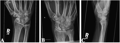 Figure 4. Plain radiographs of the right wrist joint demonstrating progressive wrist degeneration and scaphoid sclerosis/fragmentation with narrowing of the radiocarpal joint. A & B: Posteroanterior view. C: Lateral view.