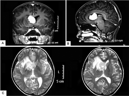 FIGURE 1  Brain magnetic resonance imaging of the patient before treatment. (A) A 3.4 × 2.3 × 2.4 cm mass in the anterior horn and body of the lateral ventricle with isointensity on the T1-weighted axial image. (B) Sagittal view of the same fragment. (C) Mass with slight edema on the T2-weighted image.