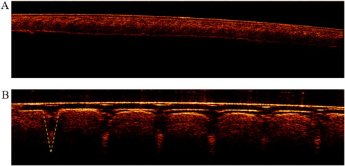 Figure 13. The optical coherence tomography (OCT) images of DMNs (A: MNs-untreated skin; B: DMNs penetration into the skin).