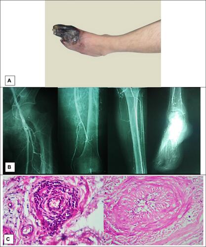 Figure 1 Case 1, (A) gangrene of forefoot; (B) angiography characteristics for Buerger’s disease; (C) infiltration of inflammatory cells in all layers of the vessel and organized thrombus are suggestive for Buerger’s disease.