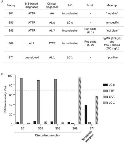 Figure 5. Cases with discordant clinical and proteomic based diagnoses (A) The proteomic based amyloid typing were discordant with the clinical diagnoses in four cases (S01, S55, S56 and S59). One case (S71) could not be unequivocally assigned with the proteomic analysis despite a clear CR staining (2+). The results from immunohistochemistry (IHC), scintigraphy (Scint.) and M-component analysis (M-comp.) are provided for each case. ‘Pos scint.’ = Scintigraphy performed with a positive result. The positive myocaridal uptake is further graded from 1 to 3 (Grade 1 (G 1): myocardial uptake < rib uptake; Grade 2 (G 2): myocardial uptake = rib uptake; Grade 3 (G 3): myocardial > rib uptake). Ambiguous M-component analysis (e.g. ‘unclear’, ‘not clear’) are denoted exactly as written in the clinical record. (B) Relative intensities (%) of the four single amyloid proteins (LC κ, TTR, SAA and LC λ) expressed in relation to the summed total intensity of the four amyloid proteins in patient samples S01, S55, S56 and S59. The proteomic based diagnoses could be unequivocally assigned in all cases.
