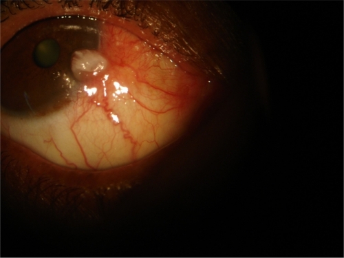 Figure 2A Right conjunctival intraepithelial neoplasia, with severe dysplasia at presentation.
