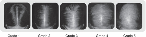 Figure 2 Sinclair Scale (CitationCollins et al 2006; CitationYip and Sinclair 2006).Grade 1: is normal. This pattern is found in all girls prior to puberty but in only forty-five percent of women aged eighty or over.Grade 2: shows a widening of the central part.Grade 3: shows a widening of the central part and thinning of the hair on either side of the central part.Grade 4: reveals the emergence of a diffuse hair loss over the top of the scalp.Grade 5: indicates advanced hair loss.