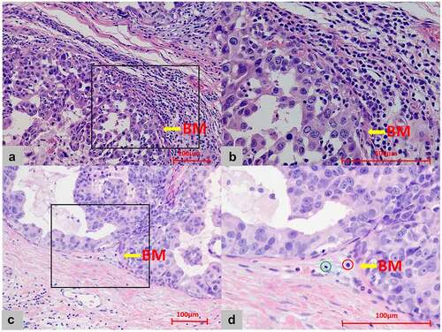 Figure 2. Touching-TILs density around DCIS. (a) Dense infiltration: the mean number of touching-TILs was more than 5 cells/DCIS duct (x20). (b) The closer view of A for dense touching-TILs (x40). (c) Sparse infiltration: the mean number of touching-TILs was 5 cells or less/DCIS duct (x20). (d) The closer view of C for sparse touching-TILs (x40, green circle: lymphocyte; red circle: plasma cell. However, both the lymphocyte and plasma cell were not identified as touching-TILs for locating far than one lymphocyte cell thickness distance from basement membrane.)