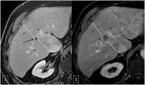 Figure 2. Minimal ablation margins measurement method. Axial T1 weighted MRI after intravenous contrast injection with an acquisition during the portal phase before microwave ablation (1) and after ablation (2). The method compared the first pre- and post-ablation MRI after contrast injection in the portal phase measuring multiple distances (a1, b1, c1, d1, e1) between the tumors (black arrow in 1) and anatomic landmarks and ablation zone (black dotted arrow in 2) and anatomic landmarks (A1, B1, C1, D1, E1) (Figure 2). For each landmark, the pre-ablation distance was subtracted from the post-ablation distance to render the margin at that site (a1-A1, a2-A2…). The smallest value was considered as the minimal margin (a1-A1 in the example).