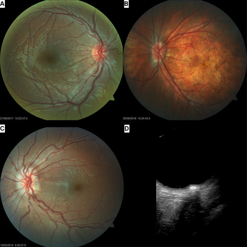 Figure 2 Optic nerve anomalies in Down syndrome. (A) Small, crowded papilla with an increased number of vessels crossing the optic disc margin, in an 11 year old boy with Down syndrome. (B) Posterior segment photograph of a 13 year old boy with Down syndrome, high myopia, tilted disc, tessellated fundus and posterior pole staphyloma. (C) Fundus imaging showing an optic disc drusen in a 16 year girl with Down syndrome. (D) The aspect of the drusen in the same eye as seen with B-scan ultrasonography.