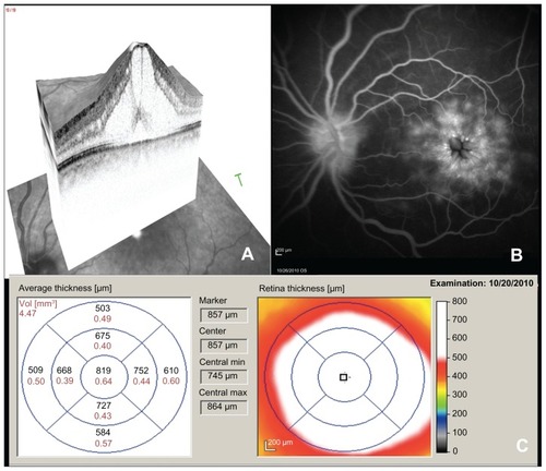 Figure 1 Spectral domain optical coherence tomography (A), fluorescein angiogram (B), and spectral domain optical coherence tomography thickness map (C) of the left eye prior to treatment with difluprednate.
