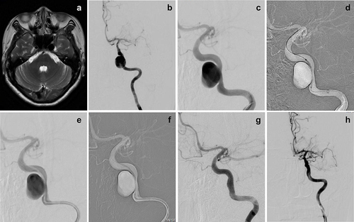Figure 2 A 54-year-old woman with a saccular aneurysm on the C4 segment of the left ICA. (a) T2-weighted MRI showed that a mass lesion with a flow void sign was located at the left side cavernous sinus. (b and c) The preprocedural DSA image revealed a giant saccular aneurysm on the C4 segment of the left ICA. (d) The WCS was transferred to bridge the aneurysm orifice on the basis of the roadmap. (e and f) The balloon was dilated to 6 atm, and the WCS was successfully deployed. (g and h) Cerebral angiogram immediately after stent deployment showed complete occlusion of the aneurysm orifice without an endoleak.