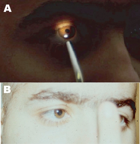 Figure 2 (A): Light reflex: Constriction of the pupil on projection of flash of light. (B): Near reflex: Convergence but no constriction of pupil on near reflex.