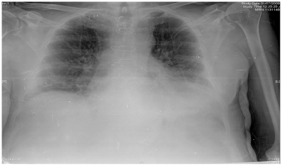 Figure 4 Chest X-ray: left lower lobe atelectasis with bilateral interstitial infiltrates.
