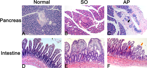 Figure 2 Pancreas and intestinal injury in AP rats. (A–C) Edema, hemorrhage, inflammation, and necrosis were observed in the pancreas in the AP group. (D–F) Edema, hemorrhage, loss in the apex of the villus, massive epithelial lifting down the sides of villi, and chyladenectasis were detected in the AP group.