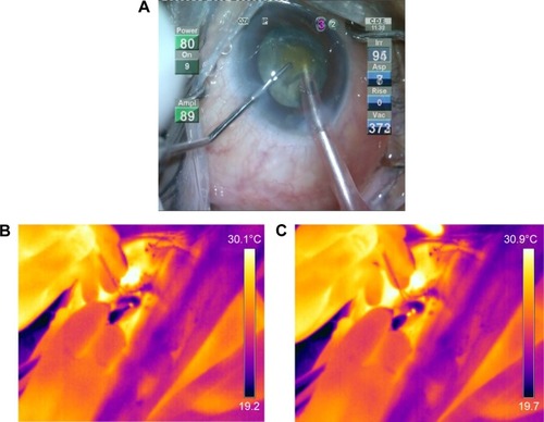 Figure 7 (A) Picture shows combined torsional and longitudinal modalities in use during surgery. (B) Thermal image shows initial elevation of temperatures at the corneal surface over the tip early on in surgery. (C) During the later phase, the whole shaft glows, producing heat signatures at the wound and corneal surface.