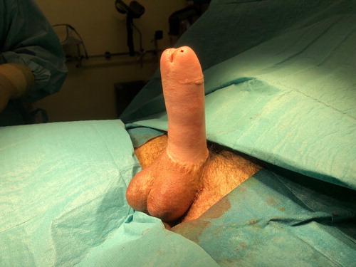 Figure 2. Result after free radial forearm phalloplasty, scrotoplasty, penile prosthesis implantation, and scrotal augmentation with testicular prostheses.