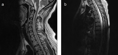 Figure 1 The key slices of the spinal cord MRI images of the case 1. (a) Cervical magnetic resonance imaging; (b)Thoracic magnetic resonance imaging.