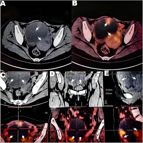 Figure 1 PET-CT (Case 1) A pelvic cystic-solid mass was considered to originate from right ovarian cystadenocarcinoma.