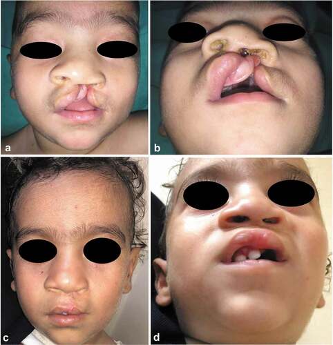 Figure 11. A case of Millard’s group; 5-month-old male, with left-sided unilateral complete cleft lip. (a and b) Preoperative frontal and submental views and (c and d) 12 months’ postoperative frontal and submental views