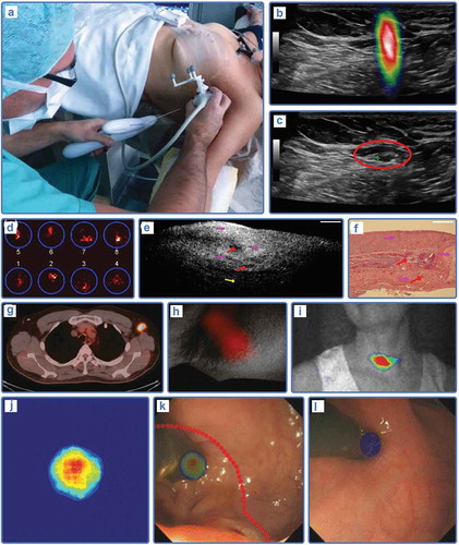 Figure 5. Multiplexing modalities for radioguided monitoring and interventions using various detection signals. (a) Setup for a SN biopsy based on the fhSPECT-ultrasound fusion (from [Citation208]). (b–c) fhSPECT-US fusion images for breast cancer SN localization (from [Citation248]). (d–f) Combined use of beta+ and OCT for ex vivo localization of 18F-FDG avid ovarian cancer lesions, showing increased radiopharmaceutical uptake with a beta+ distribution map (d), anatomical microstructure details using OCT (e) and histopathological evaluation (f) (from [Citation240]). (g) 18F-FDG avid axilla lymph nodes as shown with PET/CT can successfully be imaged with Cerenkov imaging (h) as well (from [Citation236]). (i) Similar Cerenkov imaging during thyroid therapy using 131I (from [Citation237]). (j) Intraoperative Cerenkov imaging of 18F-FDG in endoscopic surgery of rectal cancer (from [Citation239]). (k–l) Augmented reality overlay of Cerenkov images with an example of tumor tissue (k) and normal tissue (l).