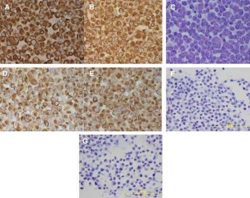 Figure 4 Immunohistochemical staining on paraffin cell blocks from PME1.