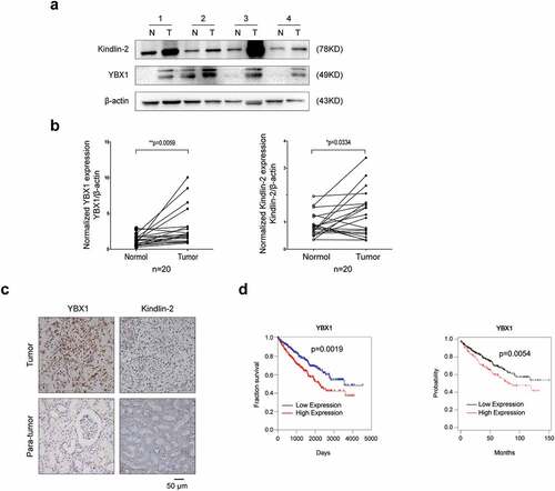 Figure 2. YBX1 and Kindlin-2 are elevated in RCC and high YBX1 expression correlates with poor prognosis in renal cancer. (a) Relative expression of YBX1 and Kindlin-2 proteins in 20 pairs of RCC tissues (T) and adjacent normal tissues (N) using western blot assay. Upper panel: representative four pairs of western blot images. Lower panel: the expressions of YBX1 and Kindlin-2 was quantified by normalizing with β-actin. The analysis was used paired t-test, P = 0.0059, P = 0.0334, respectively, n = 20. Representative images of immunohistochemical staining for YBX1 and Kindlin-2 are shown in (b). Scale bar = 50 μm. (c) High YBX1 expression correlates with poor prognosis in RCC patients. (http://www.oncolnc.org/, https://kmplot.com/analysis/) Statistically significant differences were indicated: *, P < 0.05, **, P < 0.01