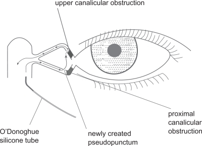 Figure 3 Diagrammatic representation of the modified retrograde dacryocystorhinostomy technique. In cases where both canaliculi are obstructed, we advocate introducing the stent through the common internal opening into either canaliculus (herein lower canaliculus) and then out from one pseudopunctum into the other before returning into the nose.