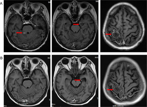 Figure 1 Brain contrast-enhanced magnetic resonance imaging (MRI) scans show brain metastases before and after anlotinib and T-DXd therapy. (A) brain metastases before anlotinib and T-DXd therapy; (B) partial response in brain metastases after anlotinib and T-DXd treatment.