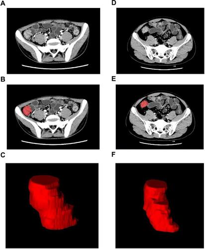 Figure 1 Three-dimensional segmentation of the CD and ITB. (A and D) CD and ITB venous ileocecal lesions. (B and E) Layer by layer delineation of lesions. (C and F) 3D ROI of ileocecal lesions.
