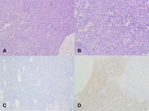 Figure 2 Pathological findings for case 1: (A) (H&E×100), (B) (H&E×200), Microscopically, tumor cells are large and polygonal, with abundant and eosinophilic cytoplasm. The nuclei were lightly stained and appeared round or ovoid, some cells were binucleated, the nucleoli were obvious, mild atypia, and mitotic figures were seen. The nuclei are lightly stained, round or ovoid, with obvious nucleoli, and some of the cells are binucleate. Slight atypia and mitotic figures are visible. The tumor has an infiltrative growth and is poorly demarcated from normal tissue. (C) negative stain for AFP(×100). (D) partial positive stain for Hepatocyte-paraffin 1(×100). Besides, we got immunohistochemical analysis as follows: PAX8(-), P53(-), P16(-), ER(-), PR(-).