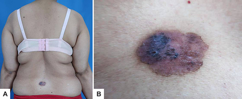 Figure 1 Dermatological examination showing: (A) A solitary lesion with an irregular shape on the waist (B) 3.5×3 x 0.1 cm of erythematous and hyperpigmented plaques.