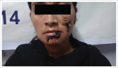 Figure 1. The woman and her daughter were bitten by a clinically confirmed rabid stray dog on face in Kullu district in April 2015. Both were given Local RIGs with IDRV and survived. But a similar patient from another area Rampur (2014), who was bitten on lower lip by a suspected rabid stray dog and given IM rabies vaccine without local RIGs, died of Rabies within 2 weeks of the bite. This demonstrates the life saving value of local RIGs with IDRV.